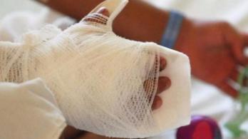 Quemados con pólvora. / Foto: Senado.