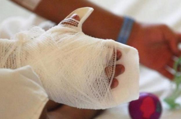 Quemados con pólvora. / Foto: Senado.