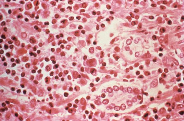 ¿Qué es el hantavirus? El virus poco común que encendió alertas tras tres muertes en un crucero