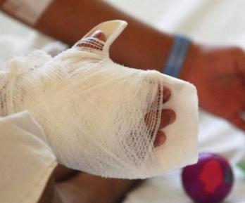 Quemados con pólvora. / Foto: Senado.