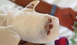 Quemados con pólvora. / Foto: Senado.