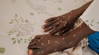Tailandia confirma su primer caso de la nueva variante de la mpox