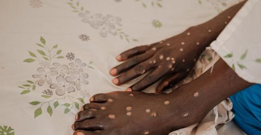 Tailandia confirma su primer caso de la nueva variante de la mpox