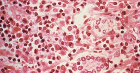 ¿Qué es el hantavirus? El virus poco común que encendió alertas tras tres muertes en un crucero