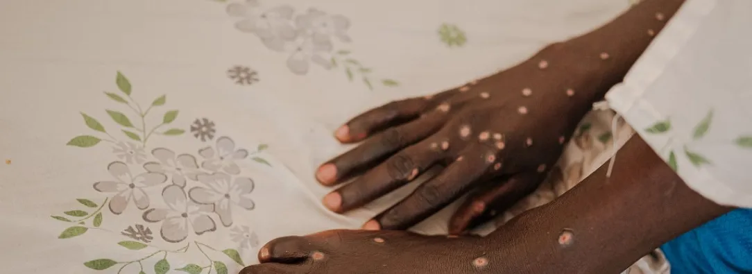 Tailandia confirma su primer caso de la nueva variante de la mpox