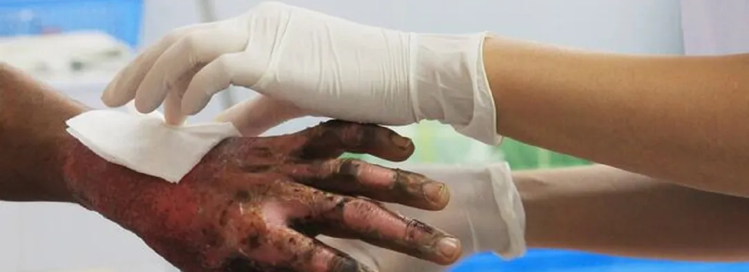 13 quemados por pólvora marcan el inicio de diciembre: preocupación por menores lesionados