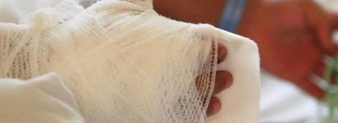 Quemados con pólvora. / Foto: Senado.