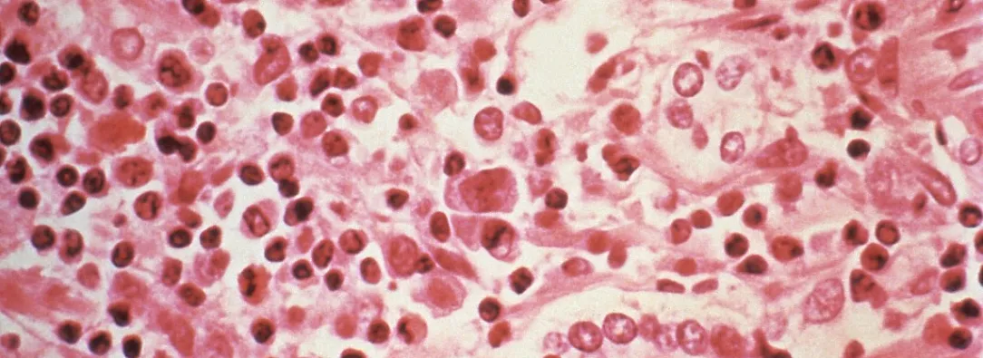 ¿Qué es el hantavirus? El virus poco común que encendió alertas tras tres muertes en un crucero