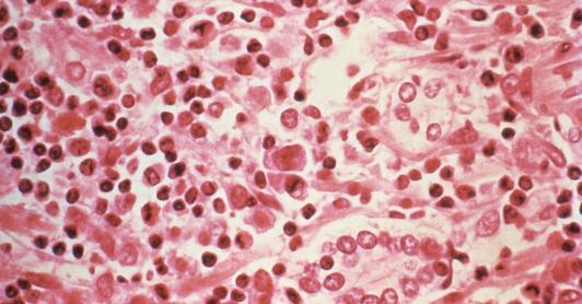 ¿Qué es el hantavirus? El virus poco común que encendió alertas tras tres muertes en un crucero